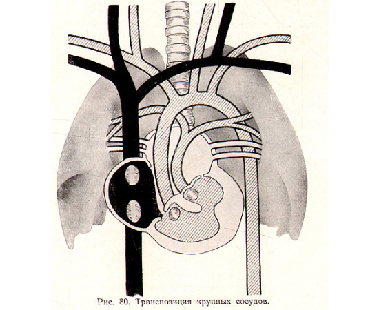 Врожденные пороки сердца и крупных сосудов